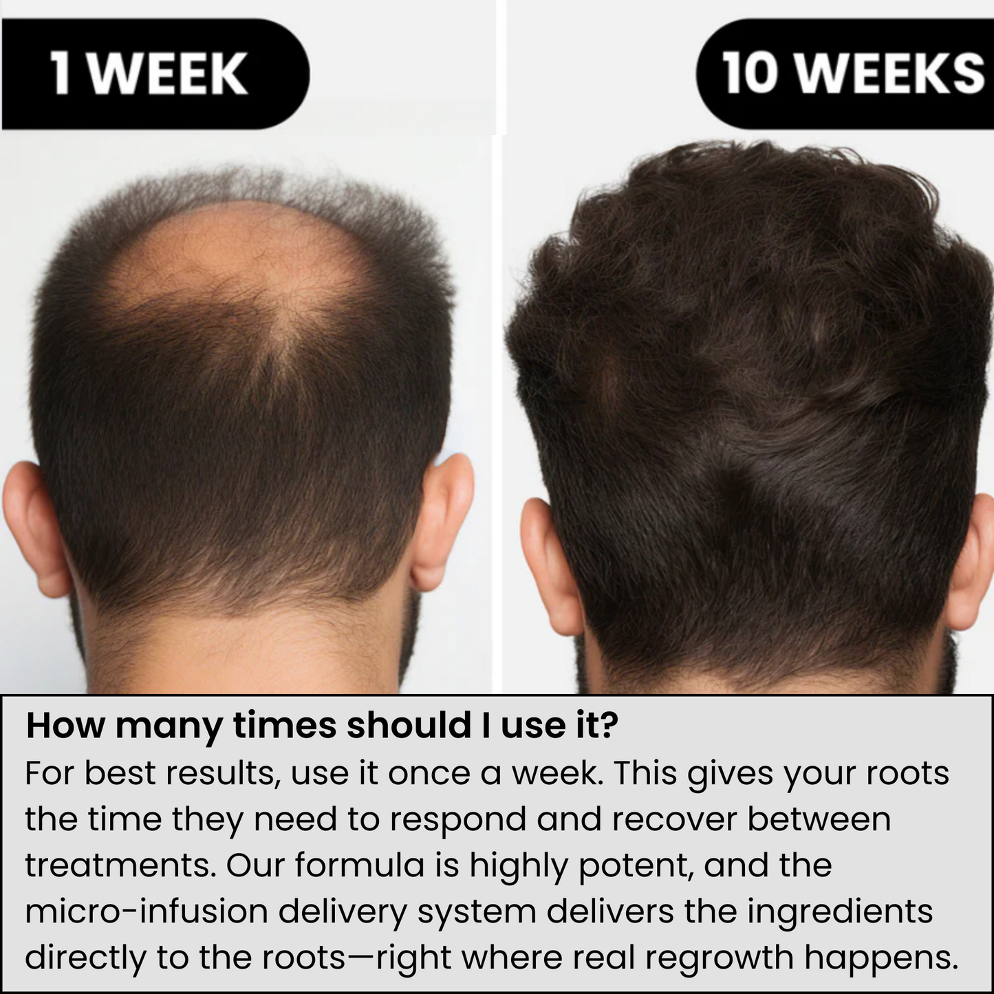 Trugro™ Hair Regrowth Kit