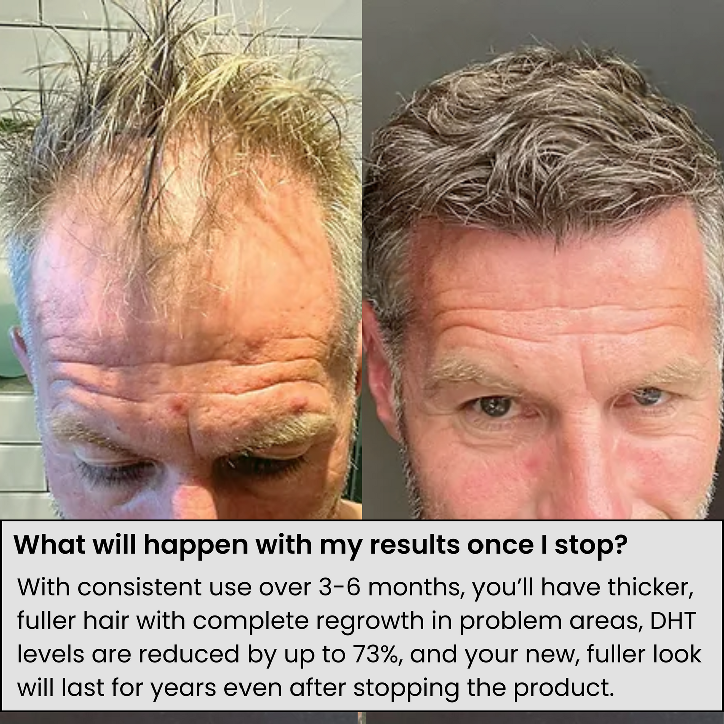 Trugro™ Hair Regrowth Kit