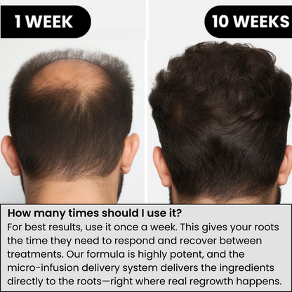 Trugro™ Hair Regrowth Kit
